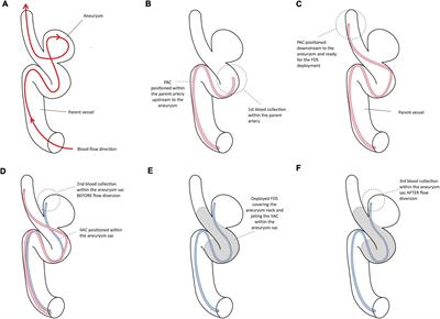 Effects of the flow diversion technique on nucleotide levels in intra-cranial aneurysms: A feasibility study providing new research perspectives